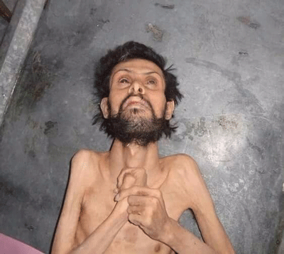 صوره لاحد المحاصرين الذين يموتون من الجوع في مضايا بسورية 