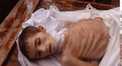 صوره لاحد المحاصرين الذين يموتون من الجوع في مضايا بسورية 